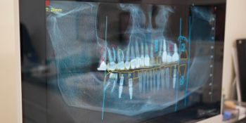 Встановлення імпланта зуба